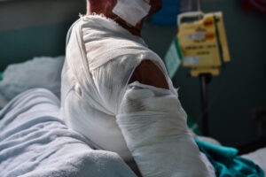 Levittown Burn Injury Lawyer