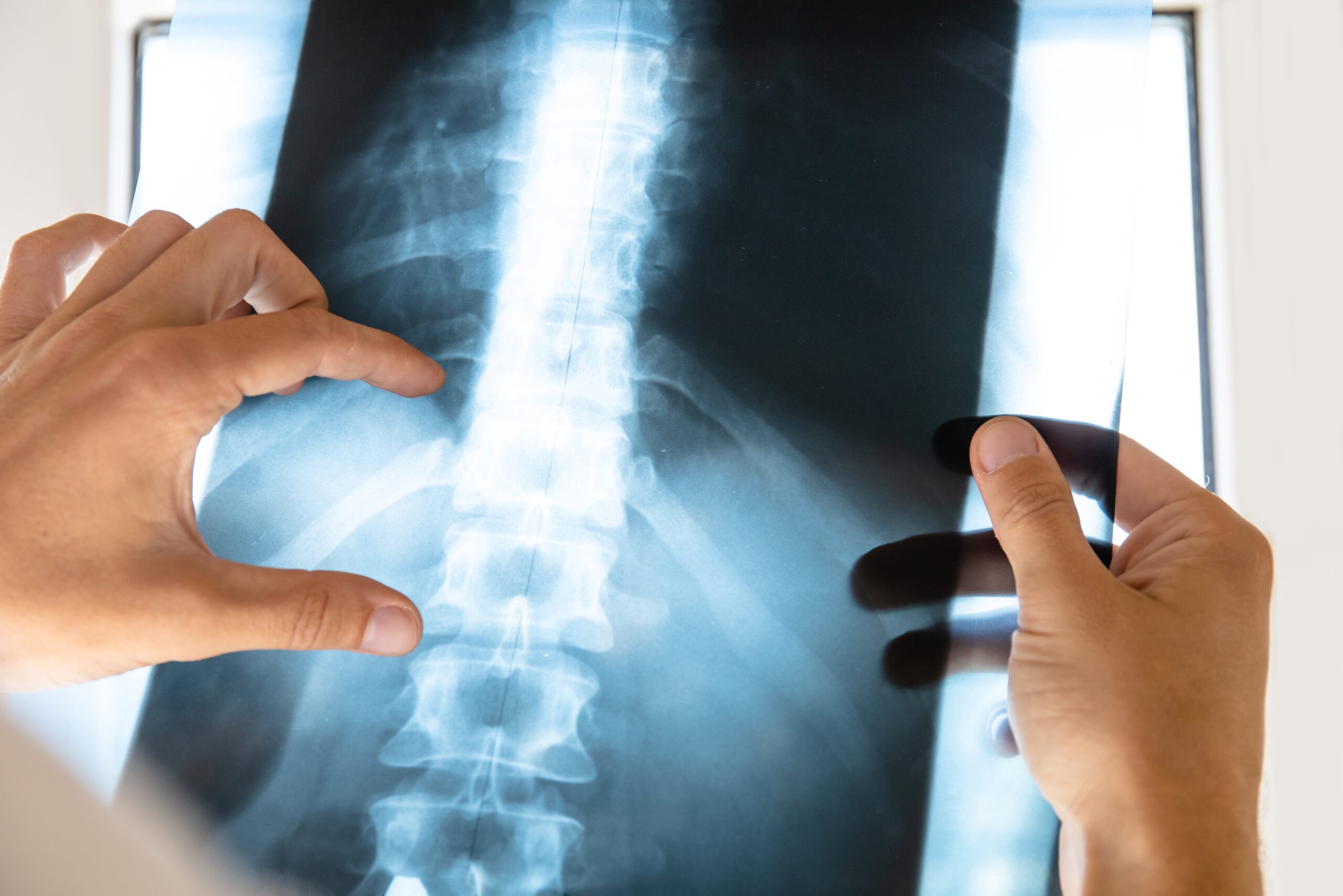 Spinal Injiry Spinal Cord Injury Lawyer | Free Consultation