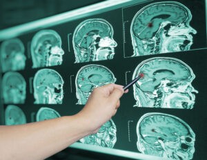 How Is Traumatic Brain Injury Diagnosed?