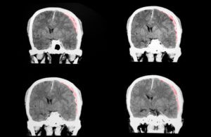 How to Hire the Best Brain Injury Accident Lawyer